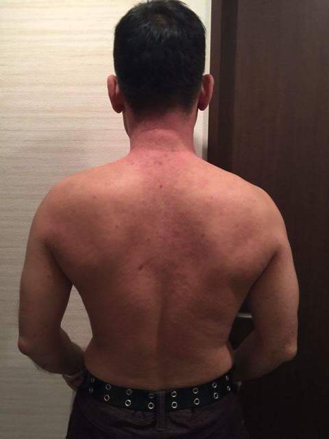 20151210背中の状態77.6kgW84cm.jpeg